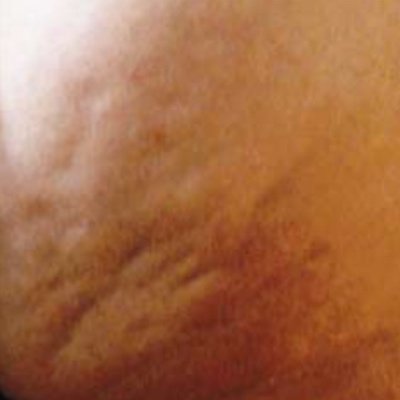 Die Cellulite ist jetzt sichtbar